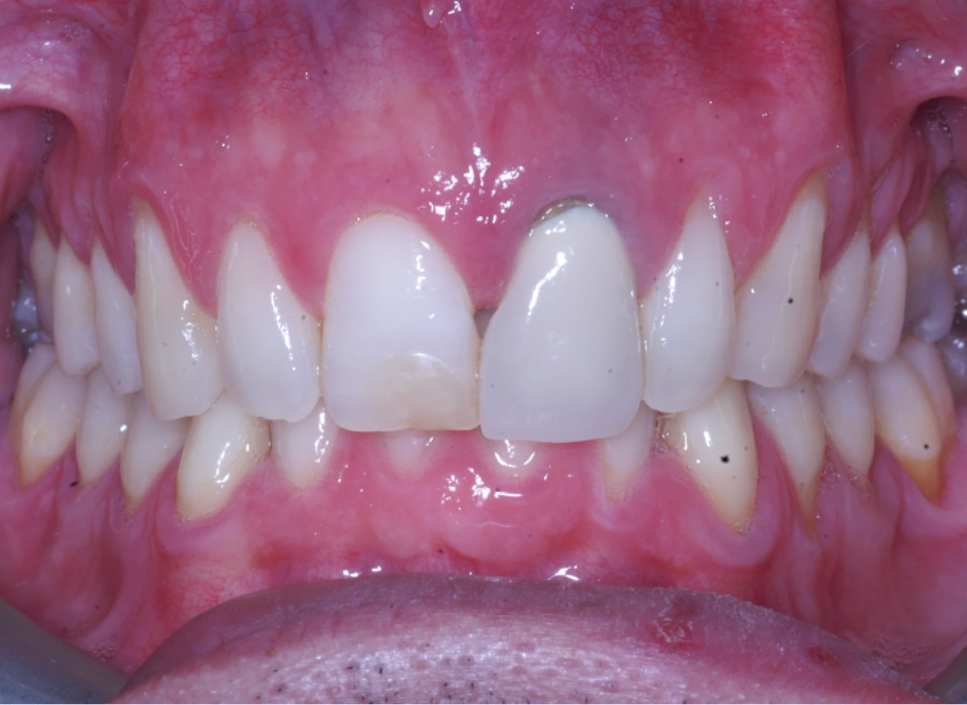 rialzi occlusali a Massa e Carrara