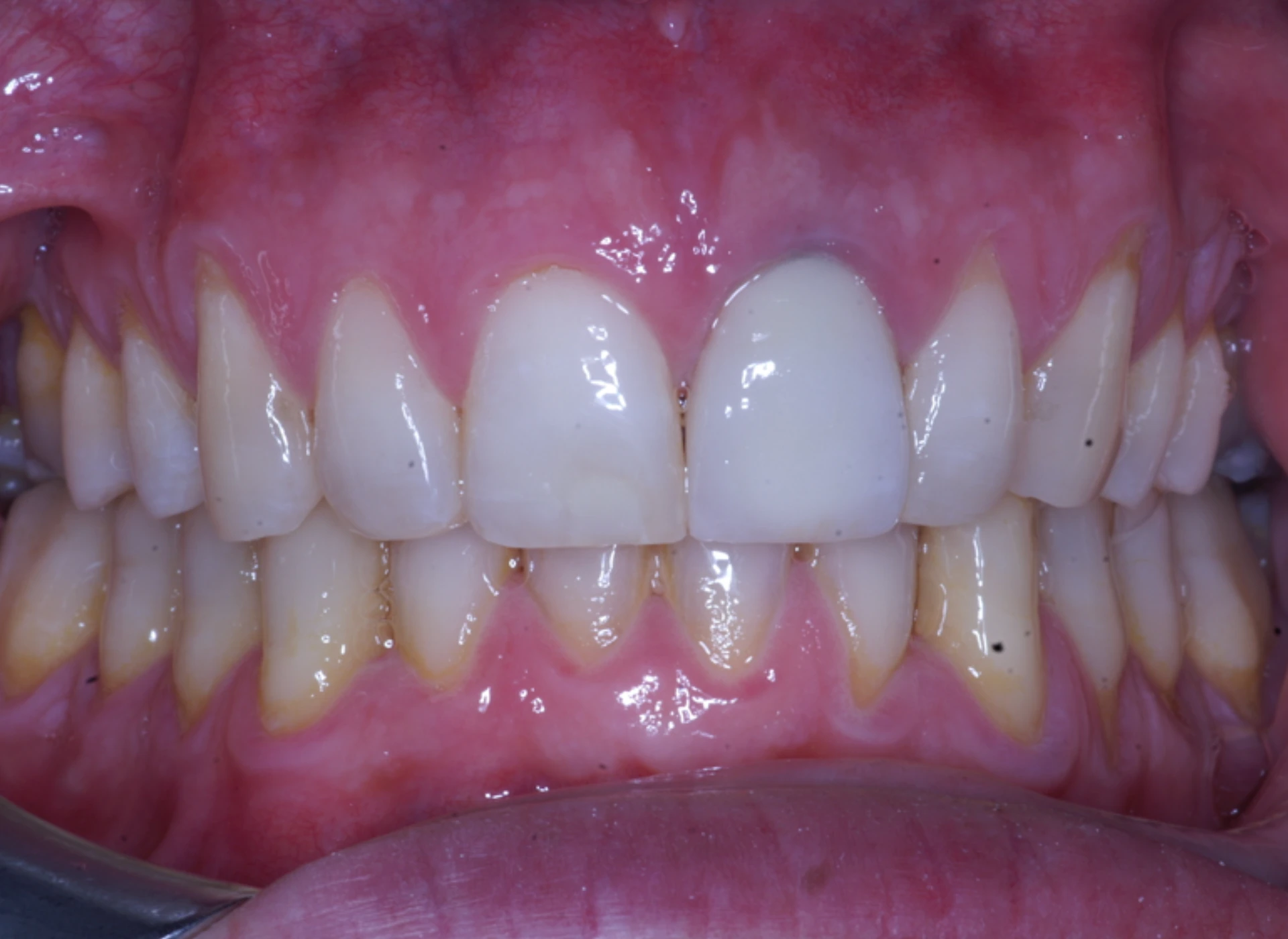 Rialzi Occlusali 7 rialzi occlusali a Massa e Carrara