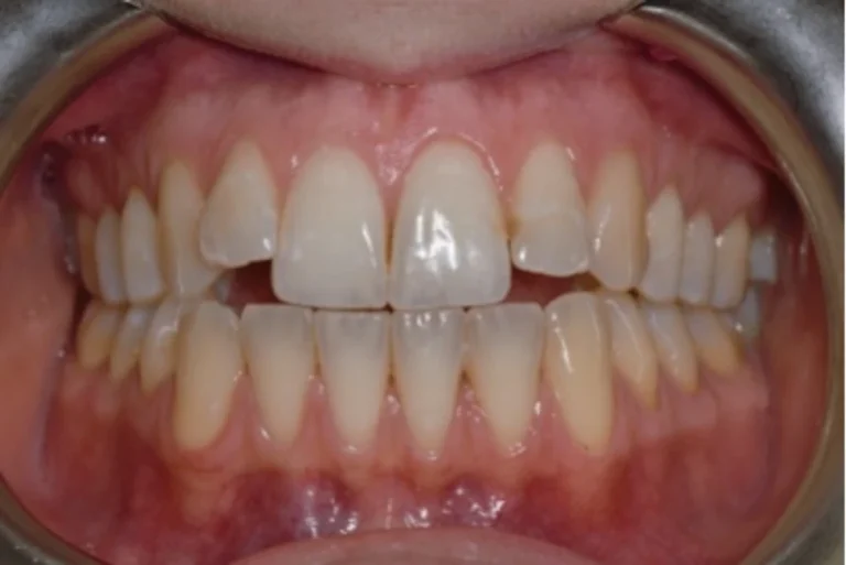 Alternativa alle faccette dentali a Massa e Carrara