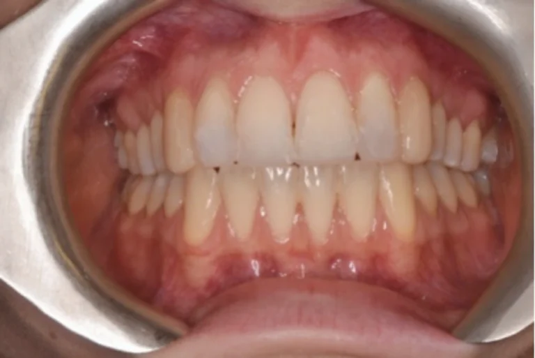 Rialzi Occlusali 7 Alternativa alle faccette dentali a Massa e Carrara
