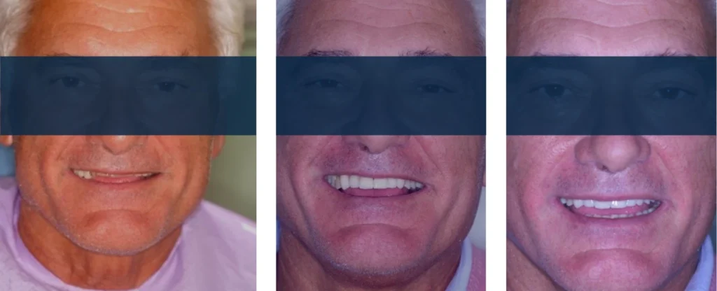 Rialzi Occlusali 12 Alternativa alle faccette dentali a Massa e Carrara