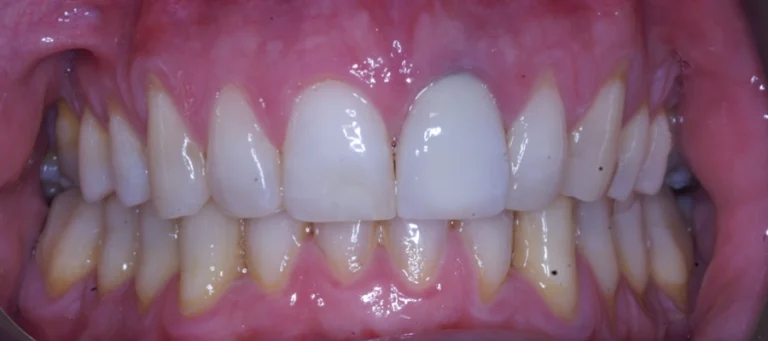 Casi prima e dopo 2 Rialzi occlusali e apertura del morso - dopo