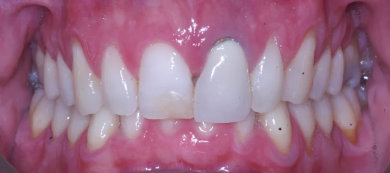 Sorrisi prima e dopo