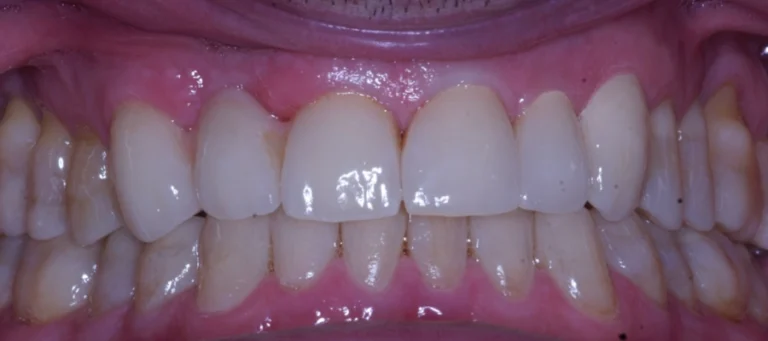 Casi prima e dopo 8 Rialzi occlusali e lavoro estetico su paziente affetto da forte bruxismo - dopo