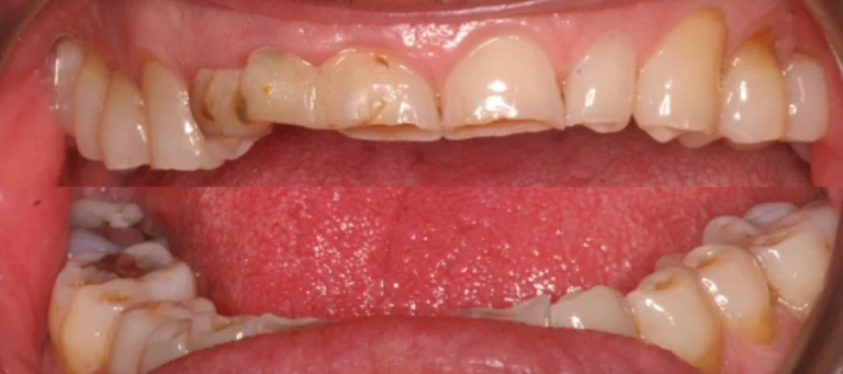 Rialzi occlusali e lavoro estetico su paziente affetto da forte bruxismo - prima