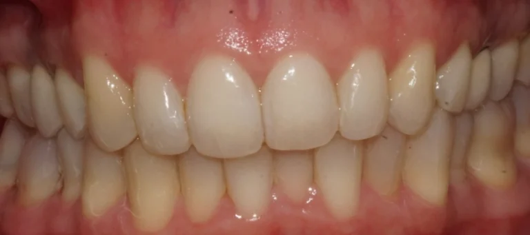 Casi prima e dopo 4 Rialzi occlusali e notevole aumento altezza dei denti - dopo