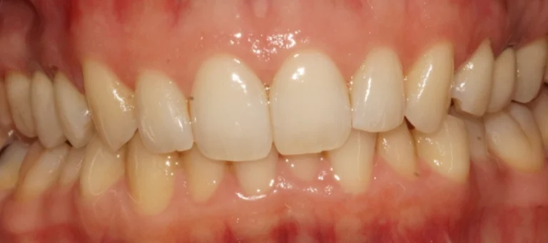 Rialzi occlusali e notevole aumento altezza dei denti - prima