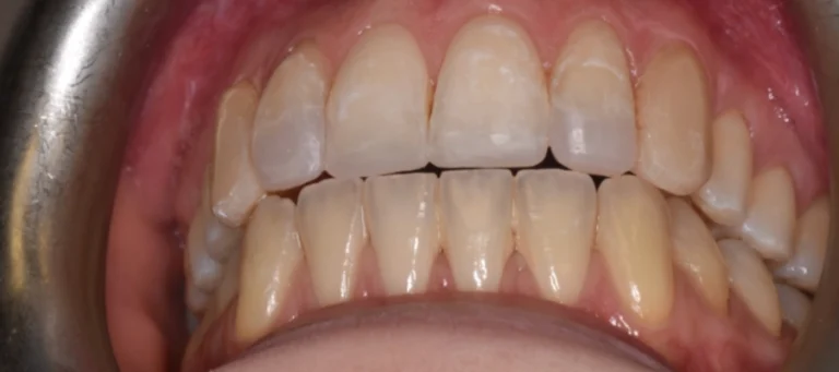 Casi prima e dopo 6 Rialzi occlusali e ripristino guida canina - dopo