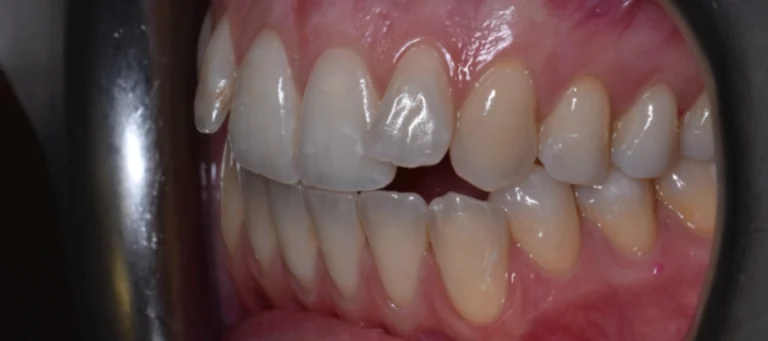 Rialzi occlusali e ripristino guida canina - prima